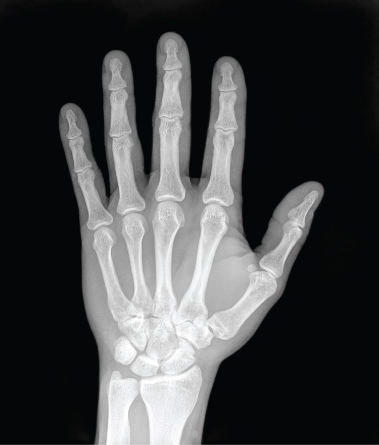 X-Ray of a Hand