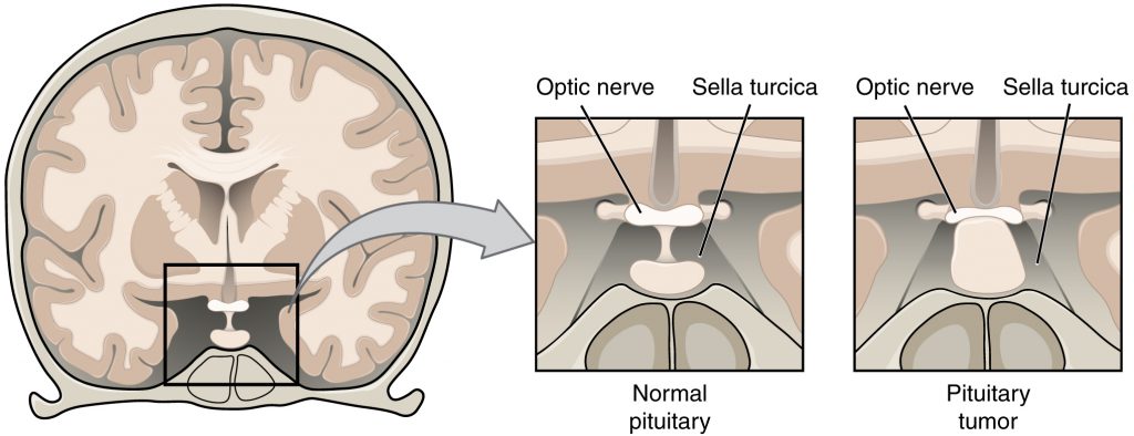 Pituitary Tumor