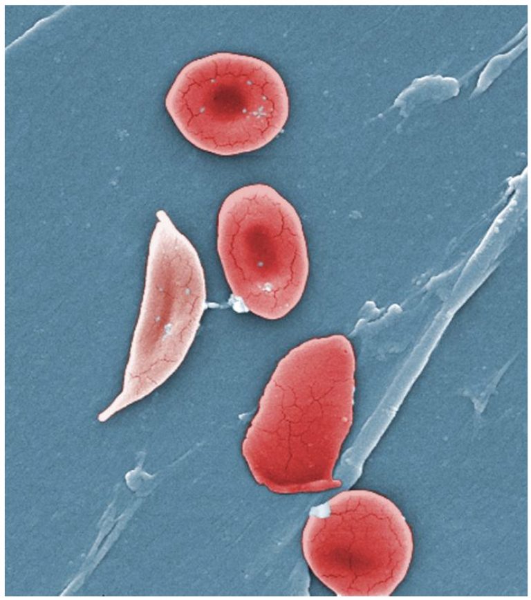 Sickle Cells