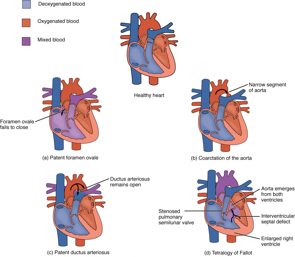 Congenital Heart Defects
