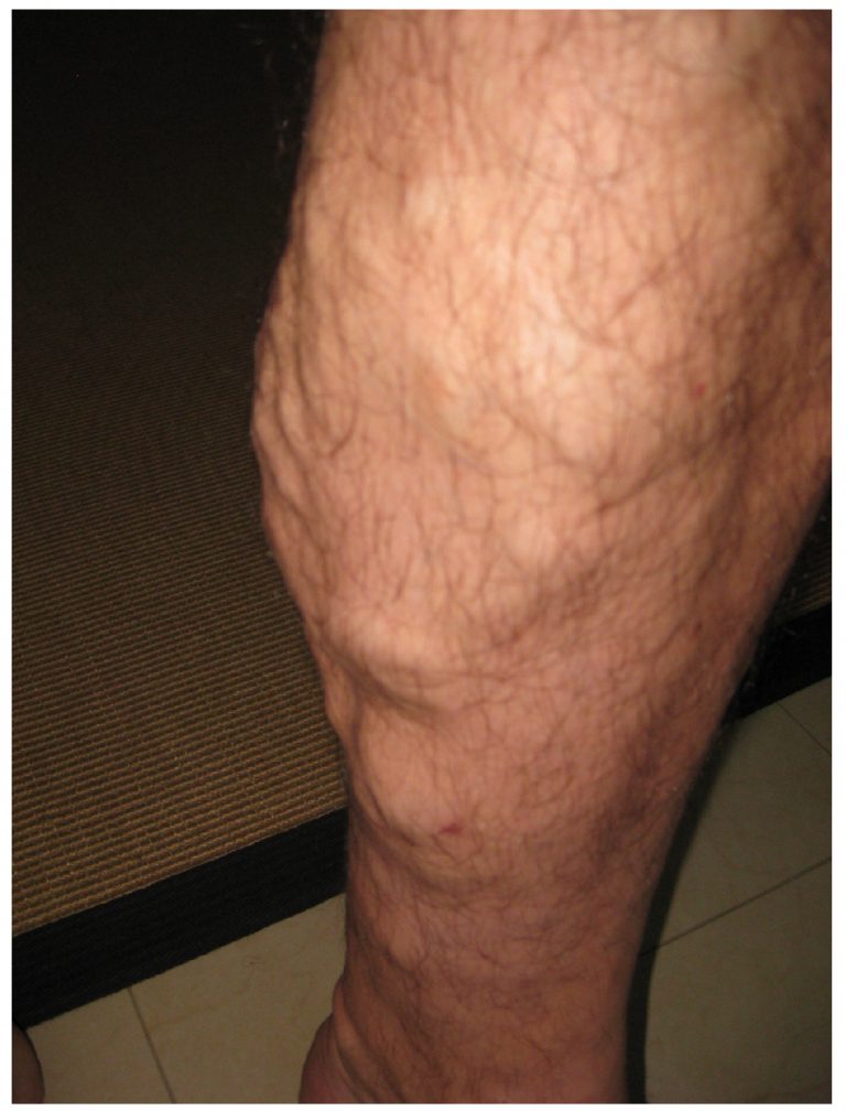 Varicose Veins