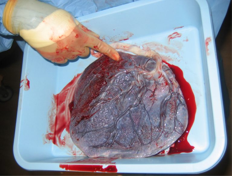 Placenta