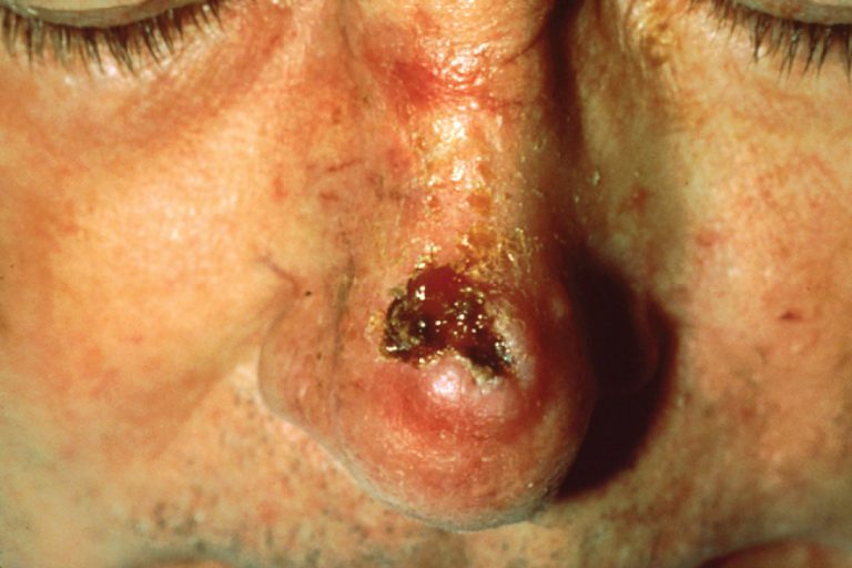 Squamous Cell Carcinoma