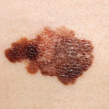 Melanoma