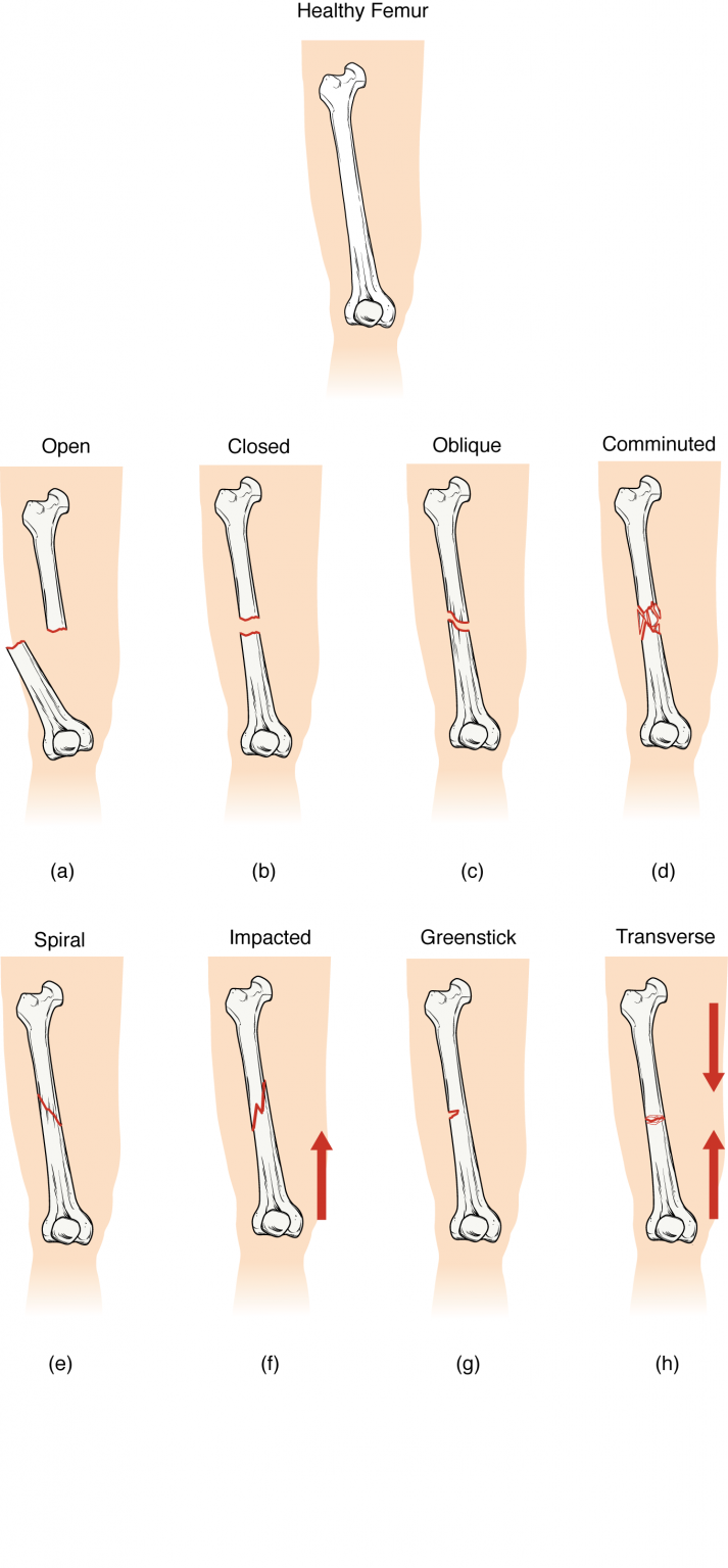 Types of Fractures