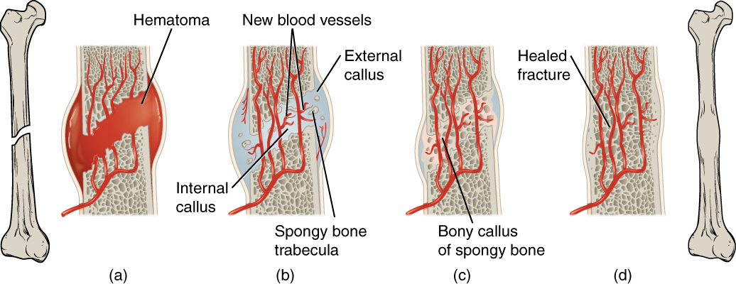 Stages in Fracture Repair