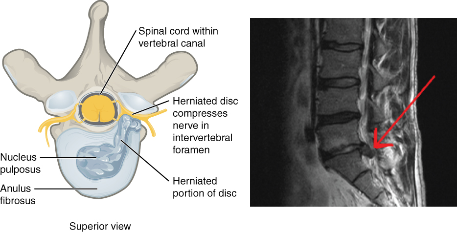 Herniated Intervertebral Disc