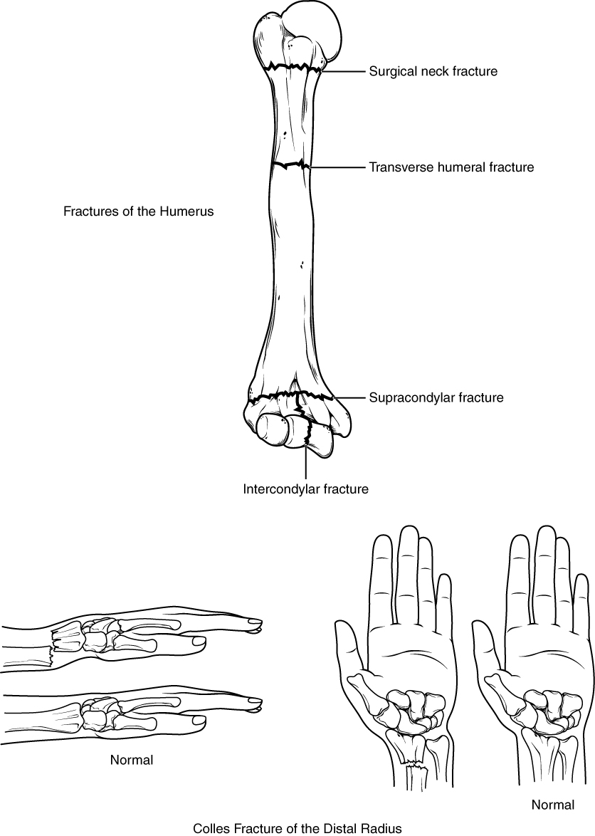 Fractures of the Humerus and Radius