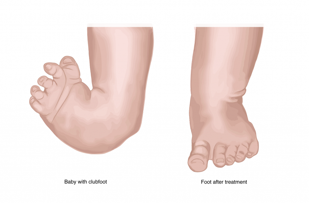 Clubfoot