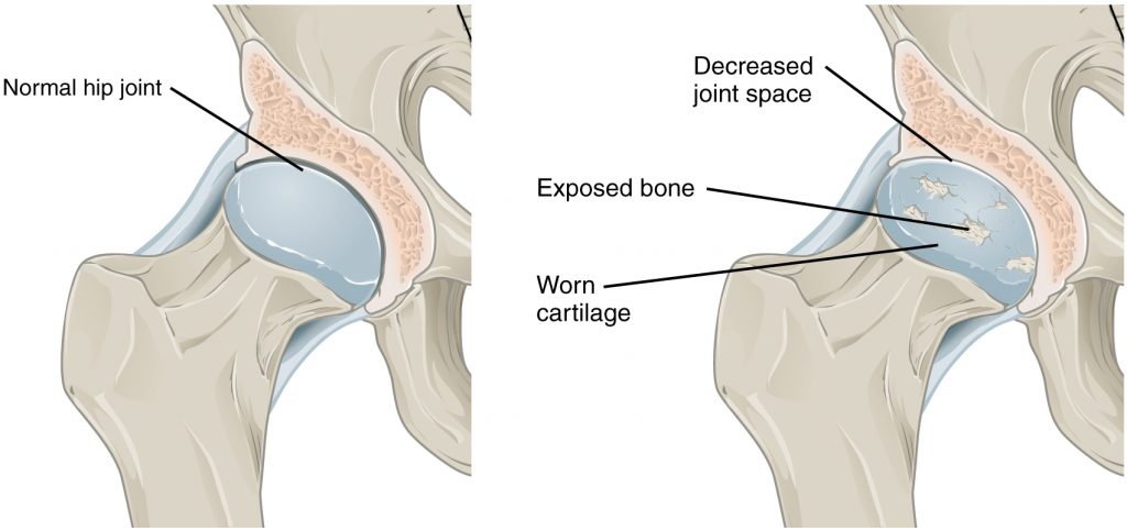 Osteoarthritis